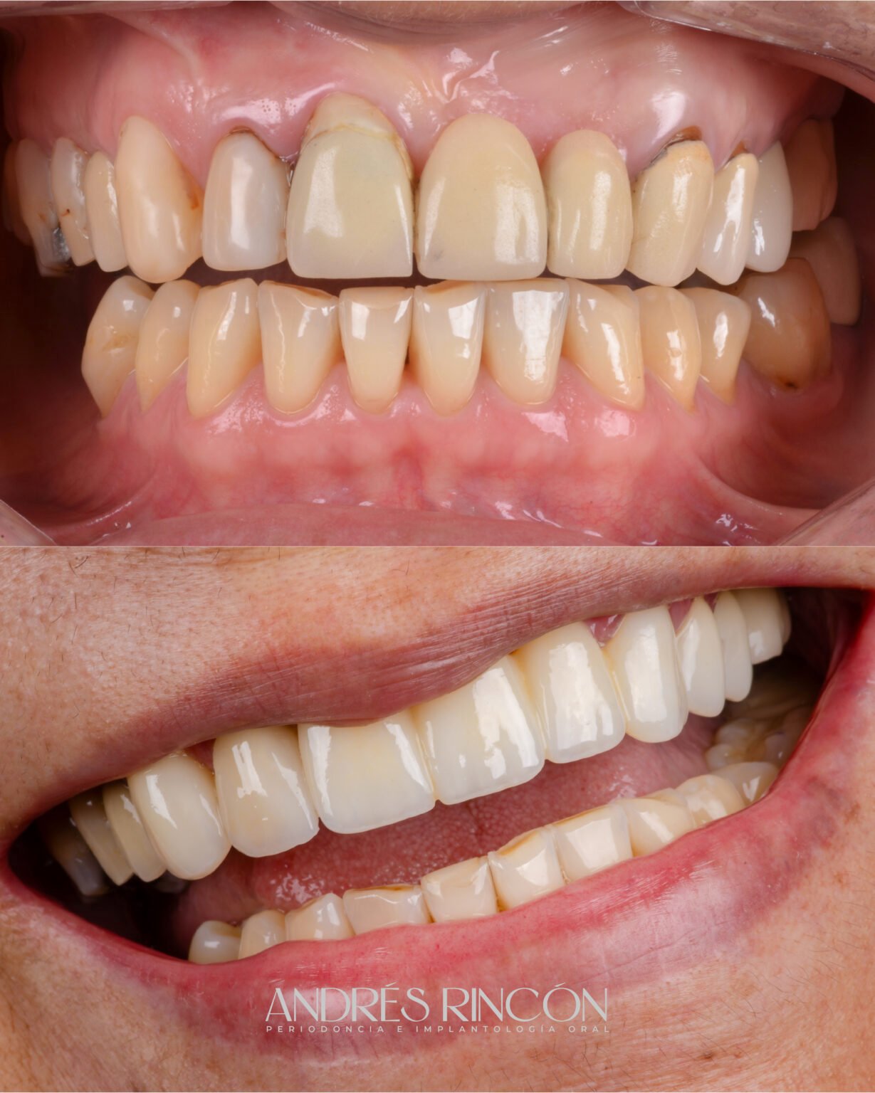 Antes y después de rehabilitación oral completa en Cali