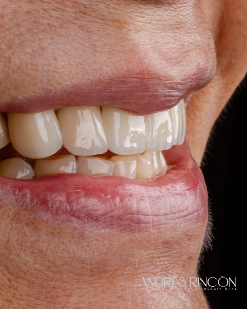 Resultado de rehabilitación oral con coronas en Cali