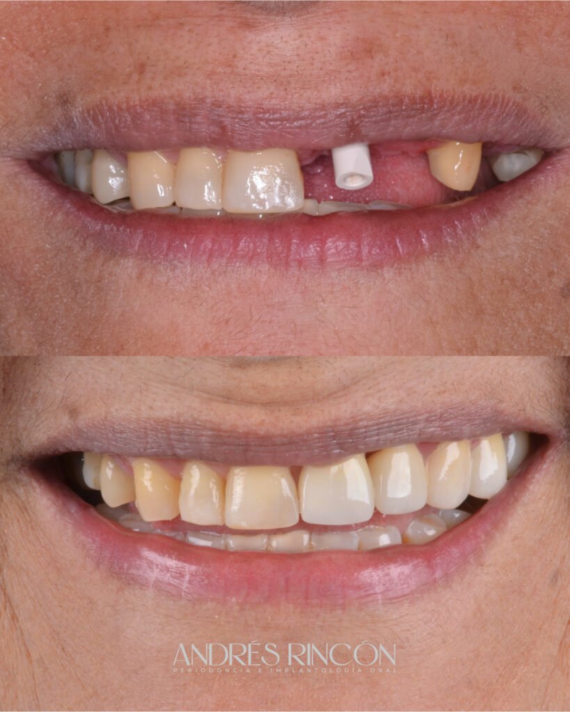 Antes y después de implante dental unitario en Cali