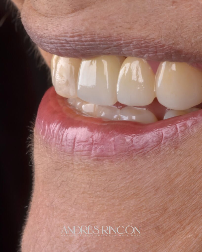 Resultado de diseño de sonrisa, vista lateral
