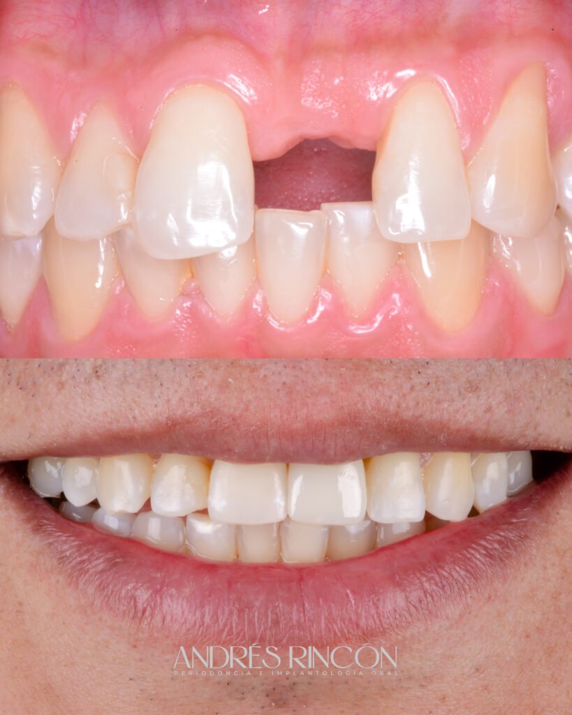 Antes y después de implante dental anterior en Cali