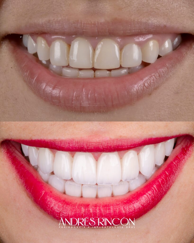 Antes y después de diseño de sonrisa con carillas de porcelana en Cali