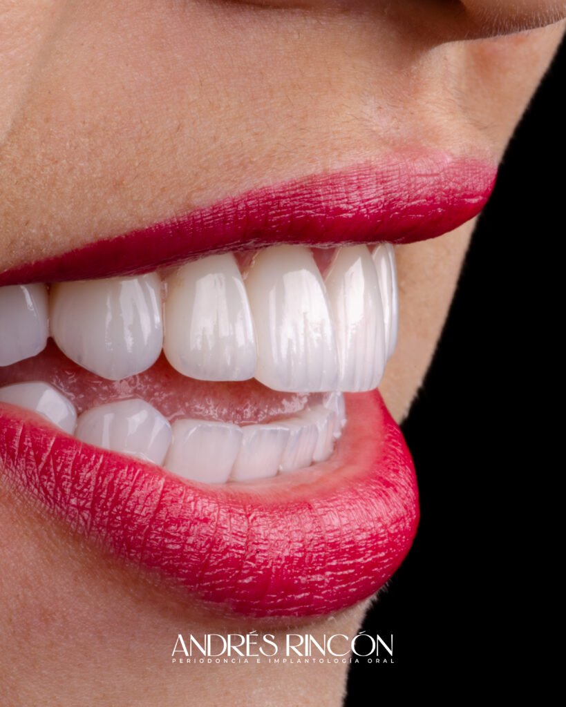Carillas de porcelana: resultado de diseño de sonrisa en Cali