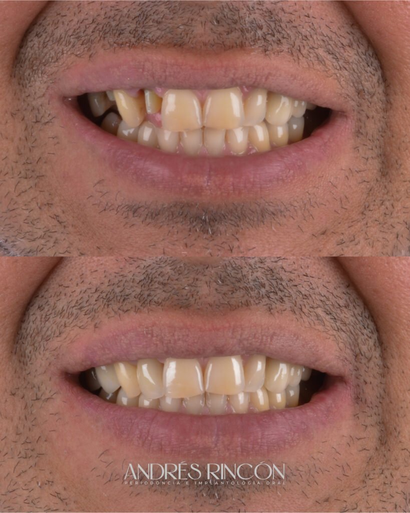 Antes y después de rehabilitación oral en Cali con el Dr. Andrés Rincón
