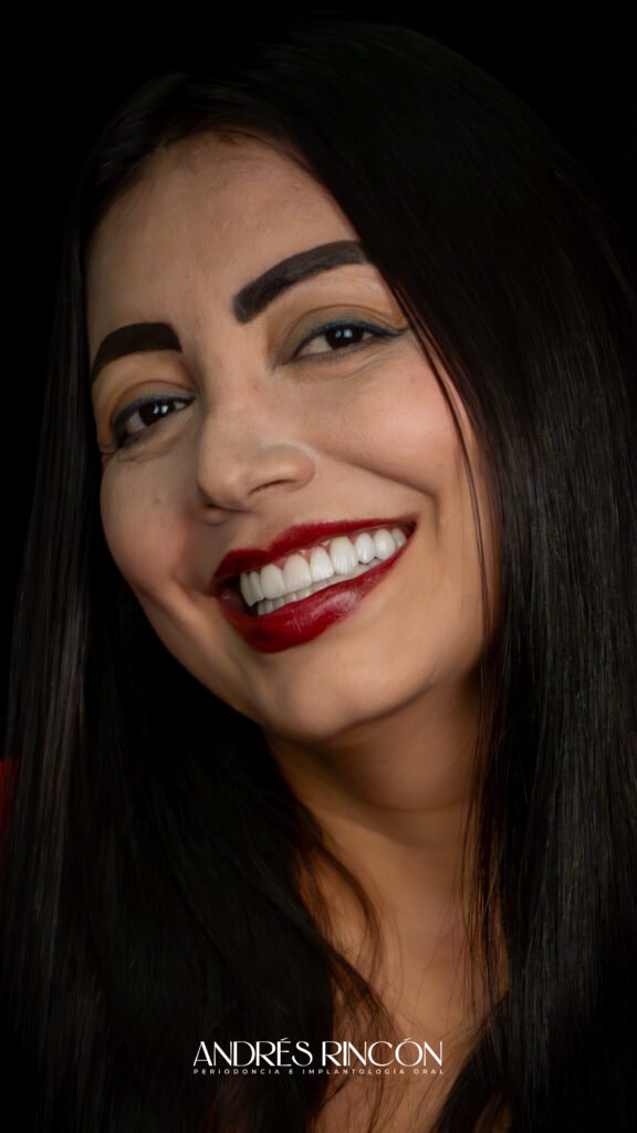 Resultado de diseño de sonrisa con carillas en Cali, Dr. Andrés Rincón
